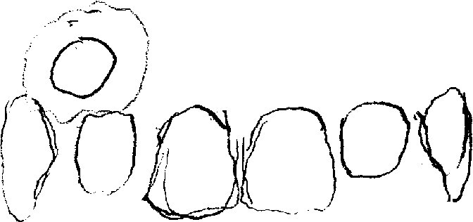 示意图:贴片位于牙齿上方的位置